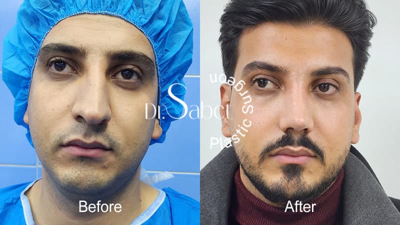 درمان پولیپ بینی | جراحی زیبایی بینی