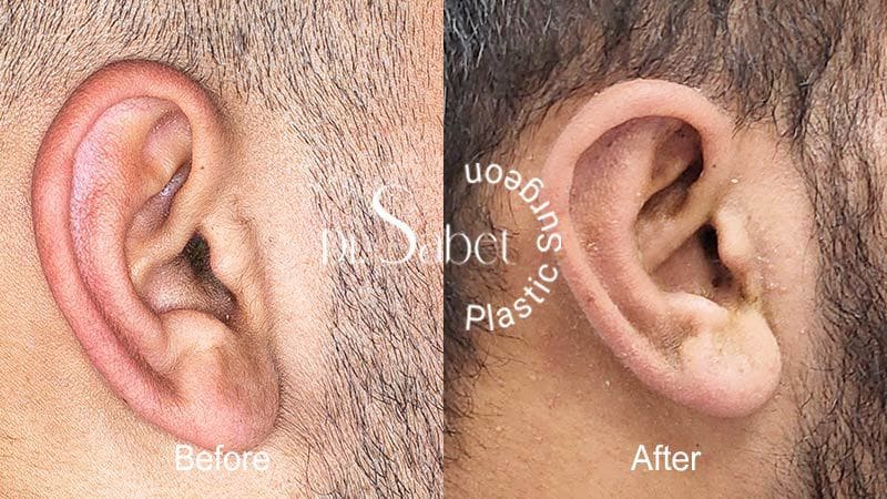 مراقبت های قبل و بعد از جراحی گوش